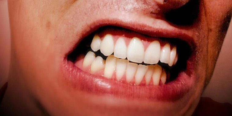 磨牙導致顳顎關節炎