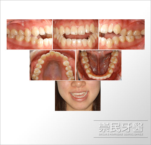 崇民牙醫診所_齒顎矯正_診療項目