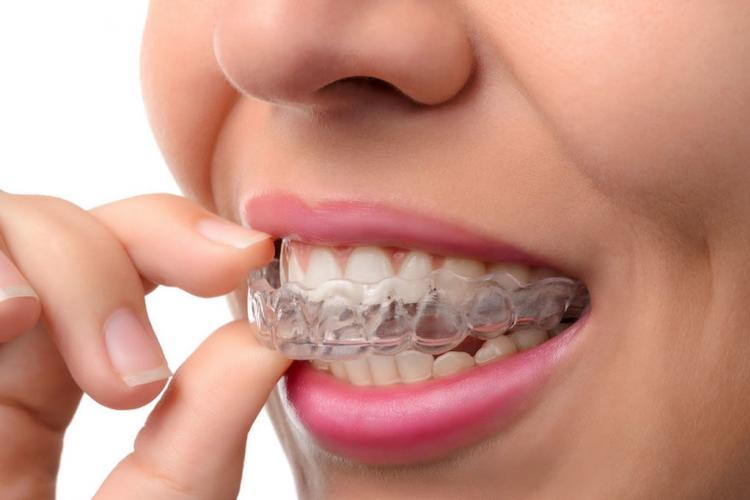 牙套可治療顳顎關節炎