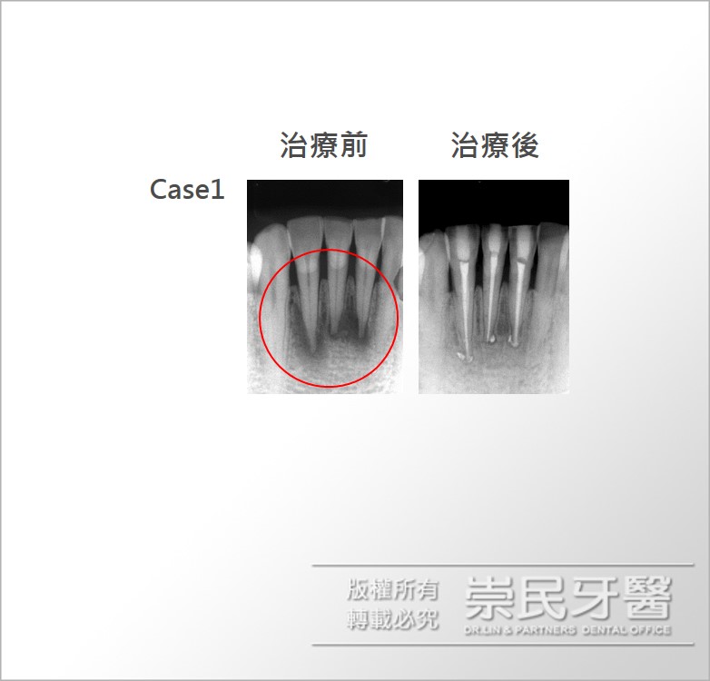 根管治療_台北