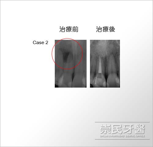 根管治療_台北