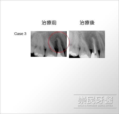 根管治療_台北