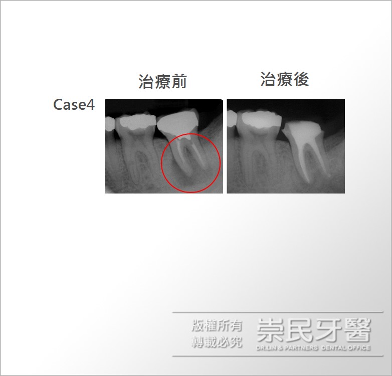 根管治療_台北